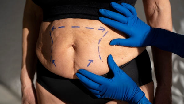 Abdominoplastie au Maroc : prix, techniques et séjour tout compris à Casablanca en 2026